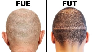 cấy tóc FUE và FUT