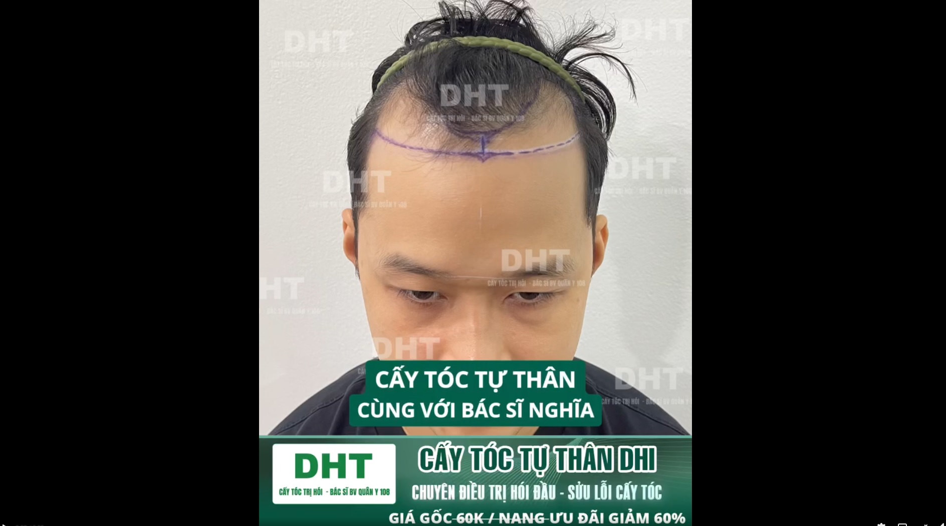 Cấy tóc DHI cùng Tiến Sĩ Bác sĩ Nguyễn Trọng Nghĩa